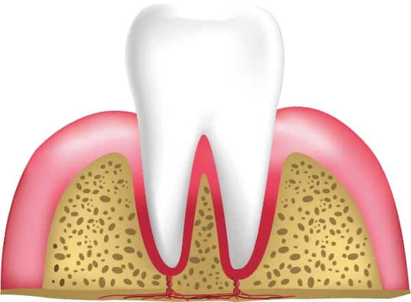 Etapas de las enfermedades periodontales: una encía sana no debe verse enrojecida ni inflamada.