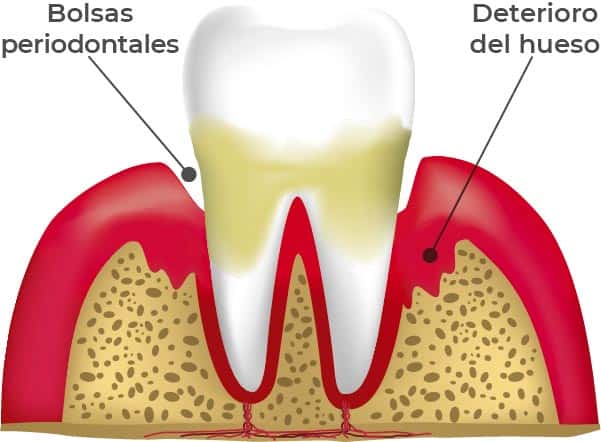 Etapas de las enfermedades periodontales: Periodintitis. En esta etapa, la encía se enrojece, se inflama y el dientes tiene sarro. Pero, además, comienza a deteriorarse el hueso.