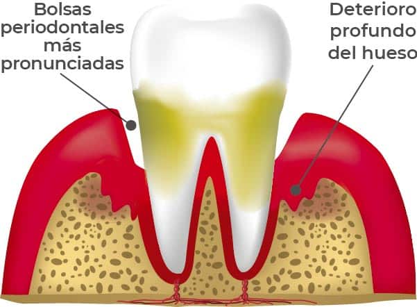 Etapas de las enfermedades periodontales: Periodintitis severa. En esta etapa el deterioro el hueso es aún mayor y, lo más factible, es que el tratamiento requiera de una cirugía.