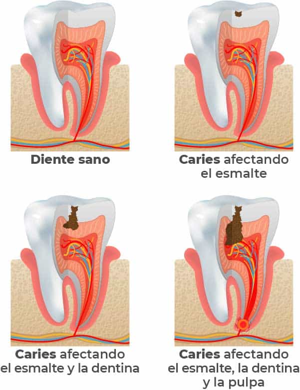 Fases de la caries dental