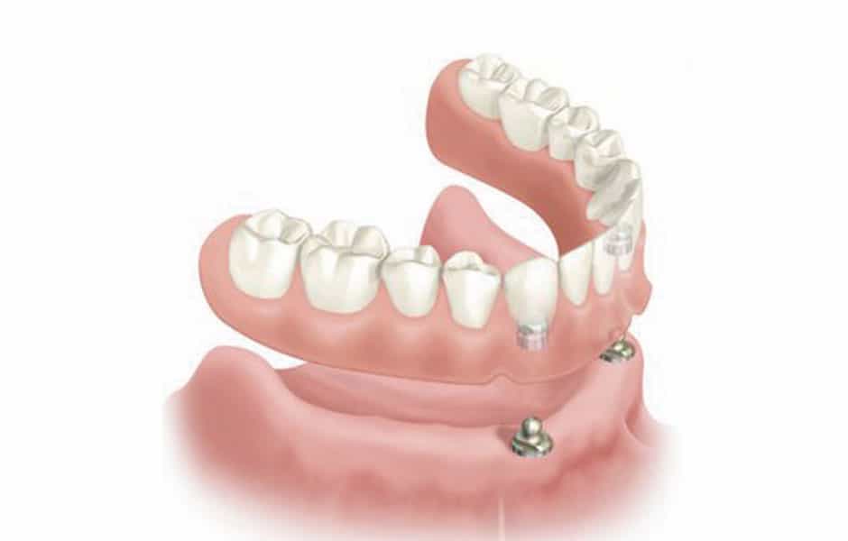 implante_dental_sobredentadura