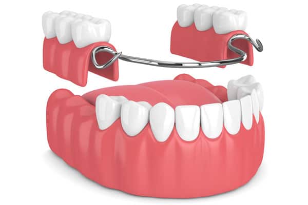 Ilustración de una prótesis dental removible