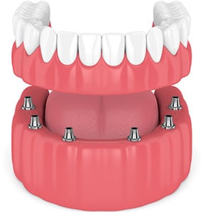 Prótesis dental: prótesis fija de dentadura completa