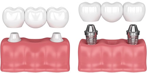 Prótesis dental: puente dental & puente sobre implantes