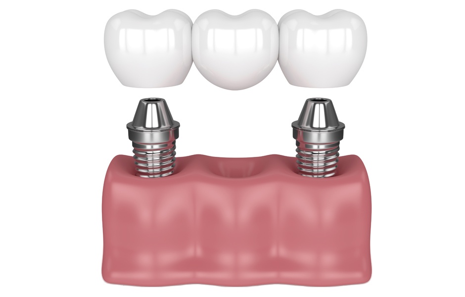 Puente sobre implantes