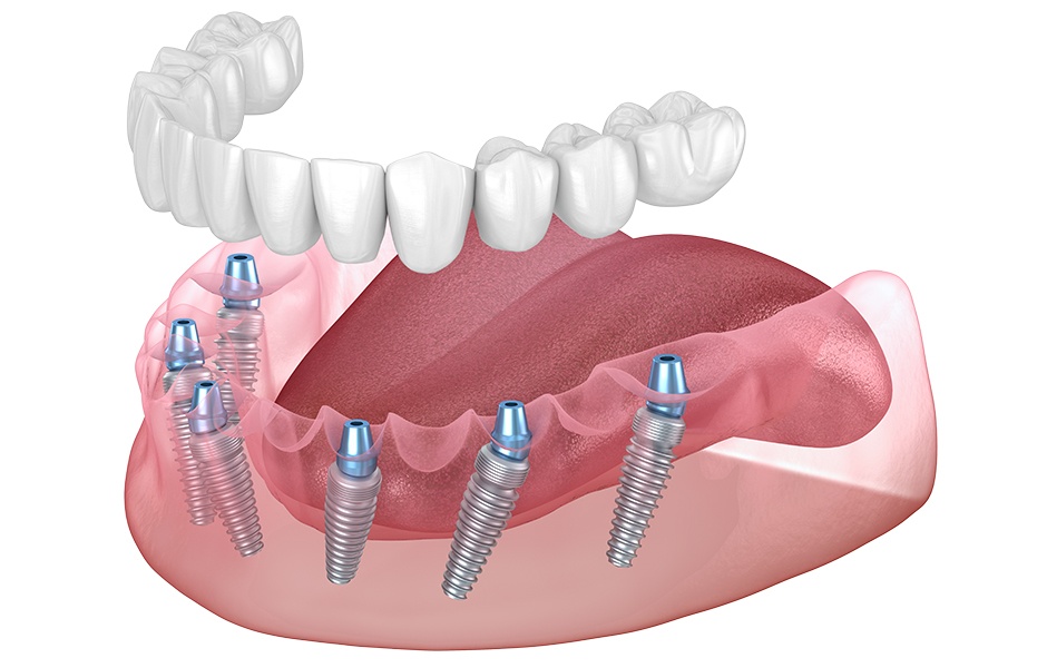 Rehabilitación completa sobre 6 implantes dentales