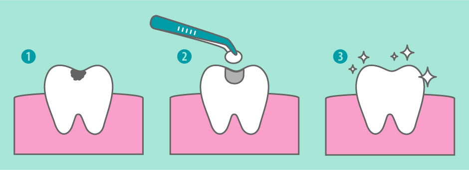 Tratamiento de empaste dental para eliminar la caries y restaurar el diente