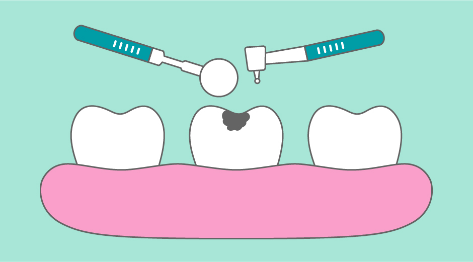 Dentista realizando un empaste dental a una paciente en la clínica DentalCompany