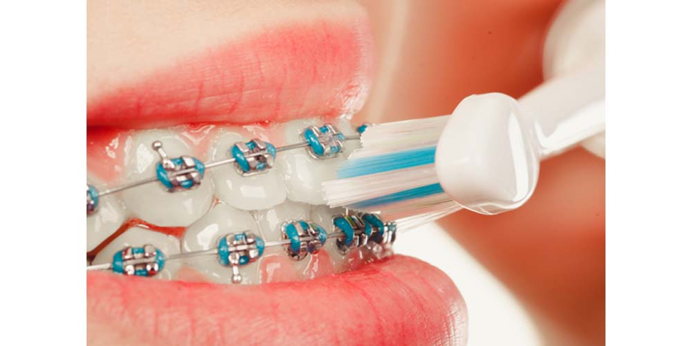 cepillado de dientes con brackets