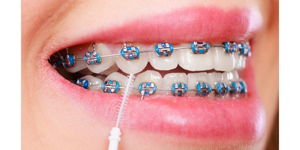 cepillado interdental de dientes con brackets