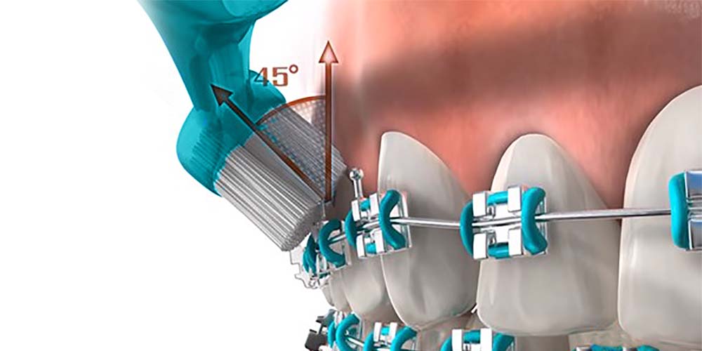 técnica de cepillado de dientes con brackets
