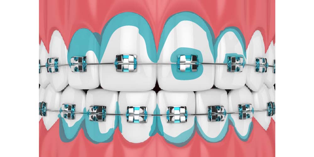 suciedad acumulada en el cepillado de dientes con brackets