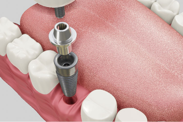 Implante dental con corona sobre encía