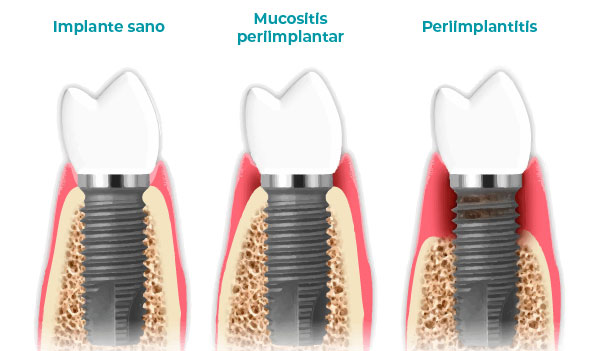 Comparativa de fases de la periimplantitis en implante dental