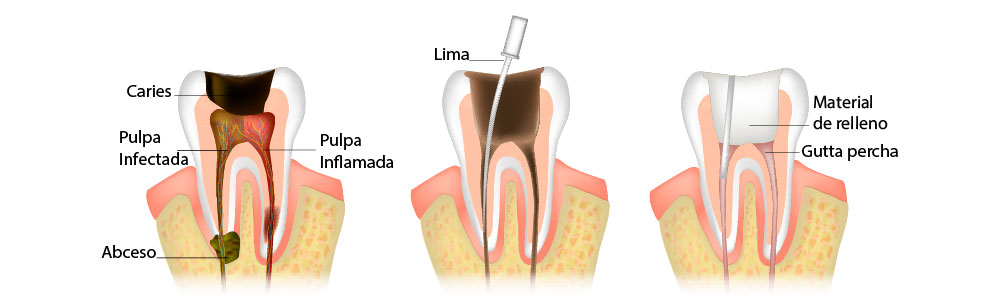 pasos para realizar endodoncia