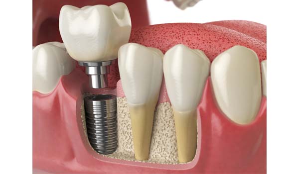 Rechazo de implante dental en encía