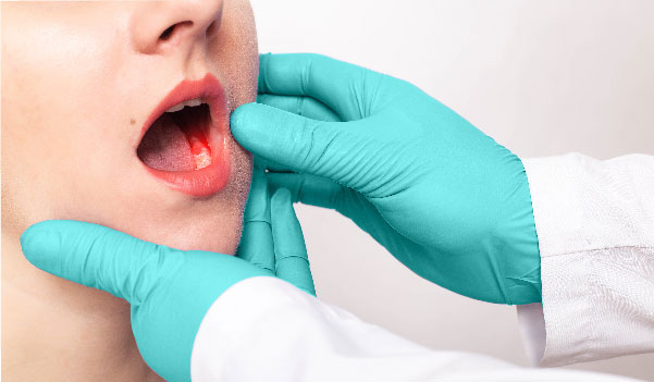 síntomas del cáncer de boca revisión