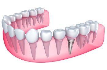 cuantos-implantes-dentales-se-pueden-poner-en-un-dia