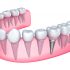 cuantos-implantes-dentales-se-pueden-poner-en-un-dia