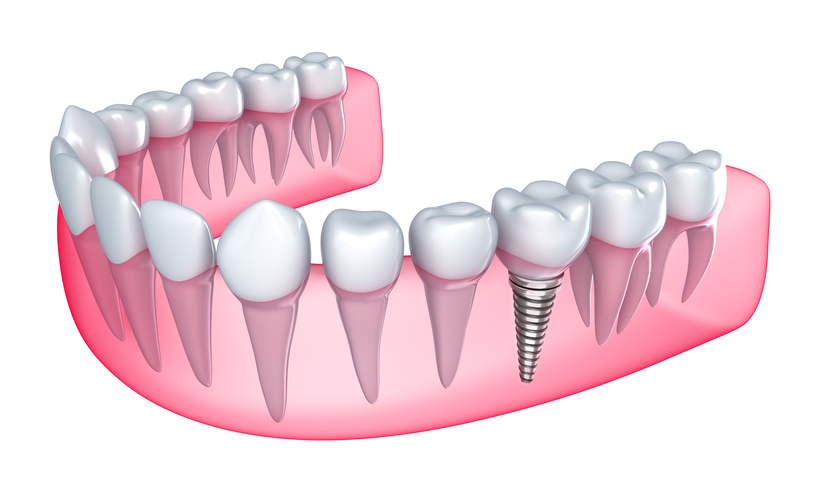 cuantos-implantes-dentales-se-pueden-poner-en-un-dia
