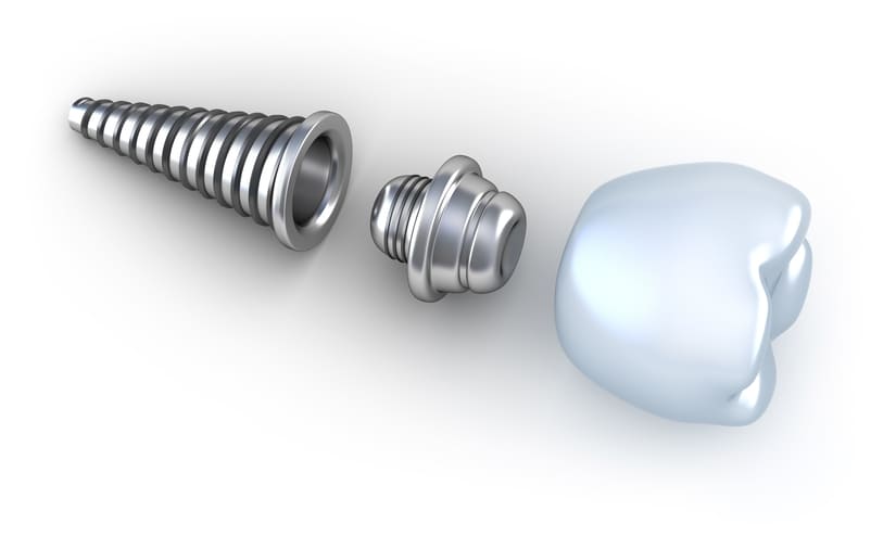 porque-se-aflojan-los-tornillos-de-los-implantes-dentales