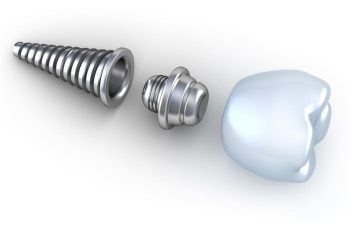 porque-se-aflojan-los-tornillos-de-los-implantes-dentales
