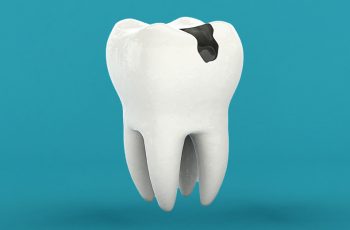 empaste-profundo-cerca-del-nervio