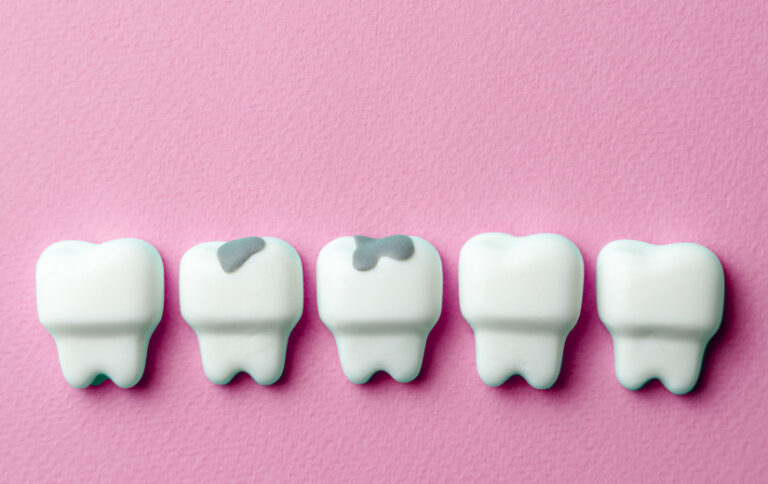 Tipos de Caries