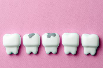 Tipos de Caries
