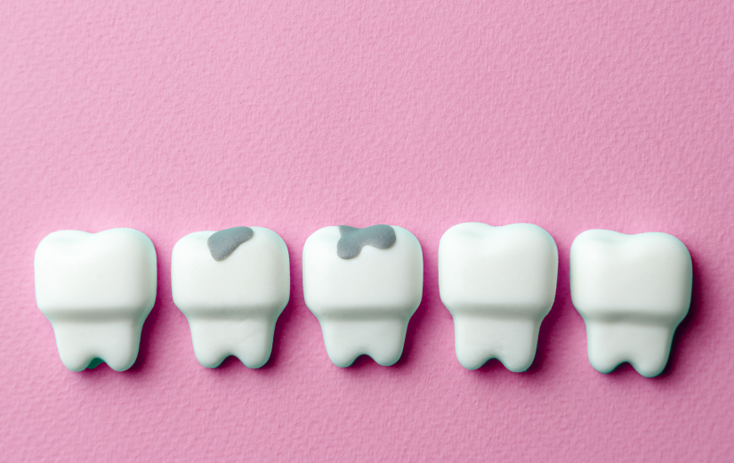 Tipos de Caries