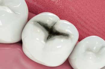 principio de caries