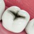 principio de caries