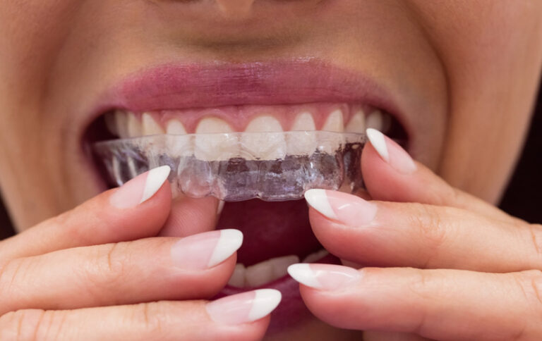 retenedor-dental