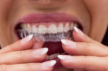 retenedor-dental
