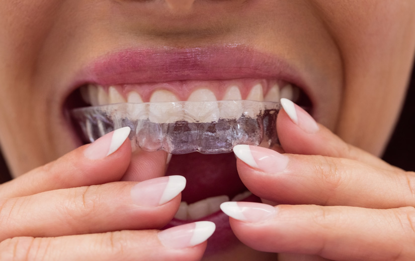 retenedor-dental