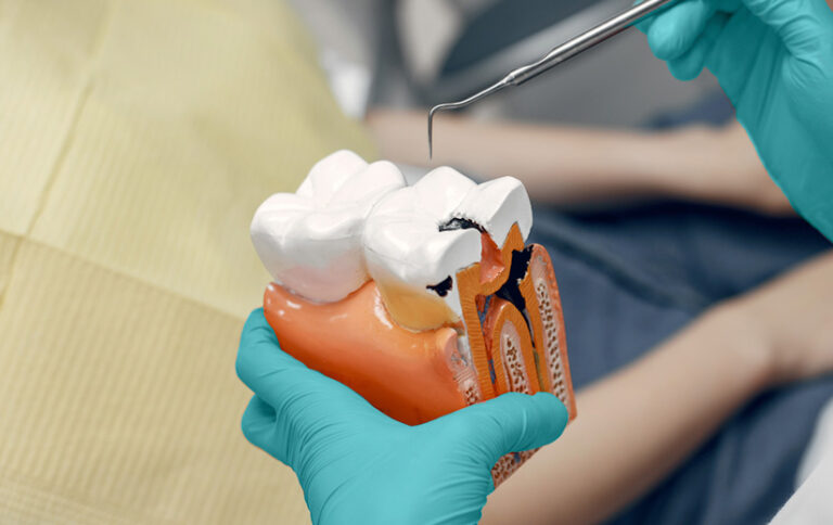 pulpitis-reversible-tratamiento