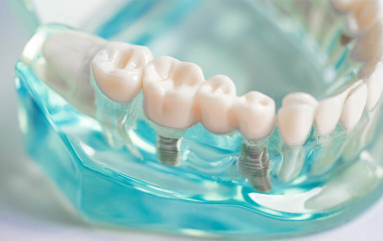 Modelo para coronas dentales