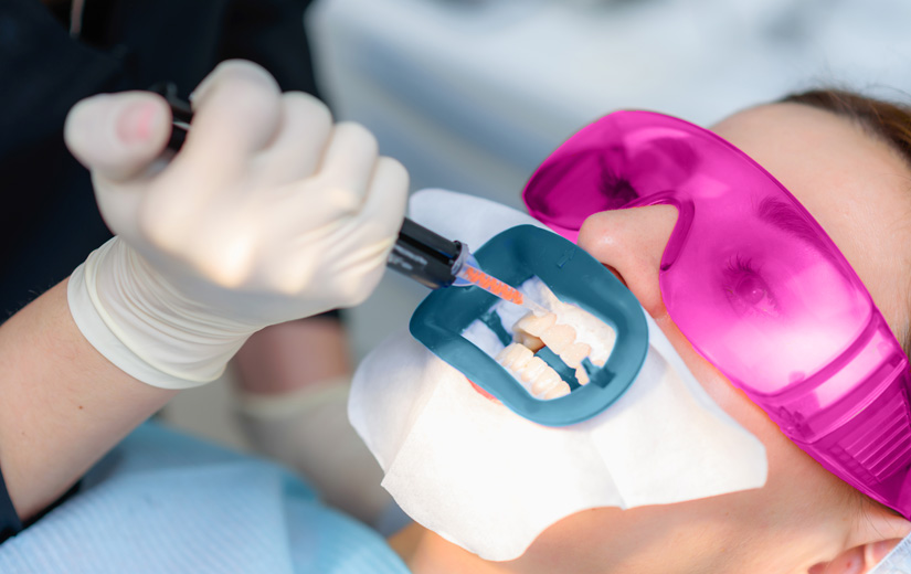tipos-de-blanqueamiento-dental