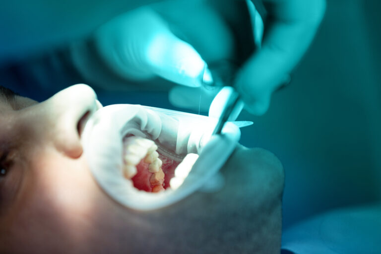 como-se-hace-una-endodoncia
