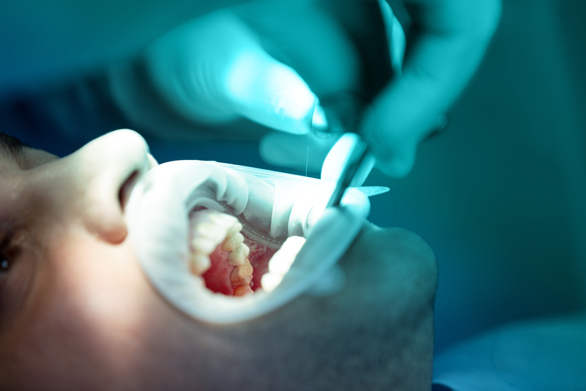 como-se-hace-una-endodoncia