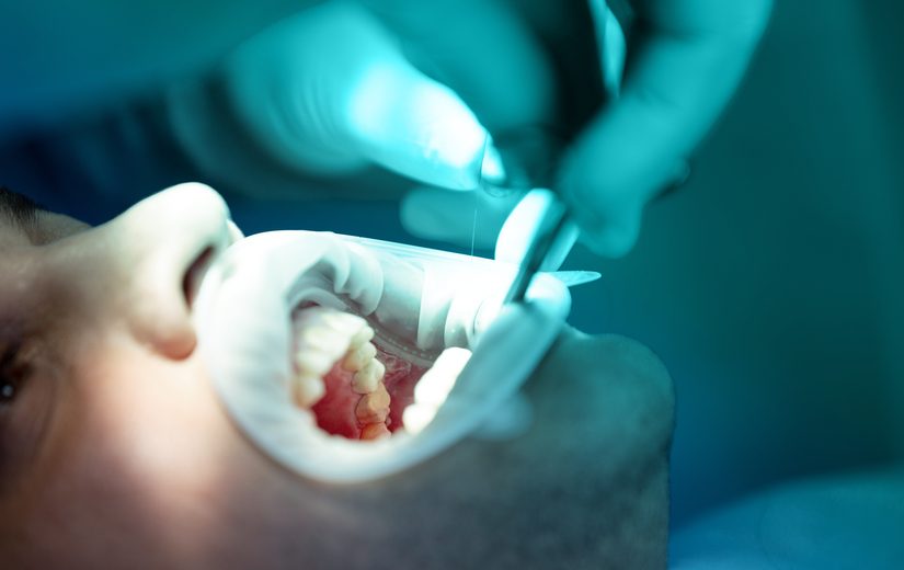 como-se-hace-una-endodoncia