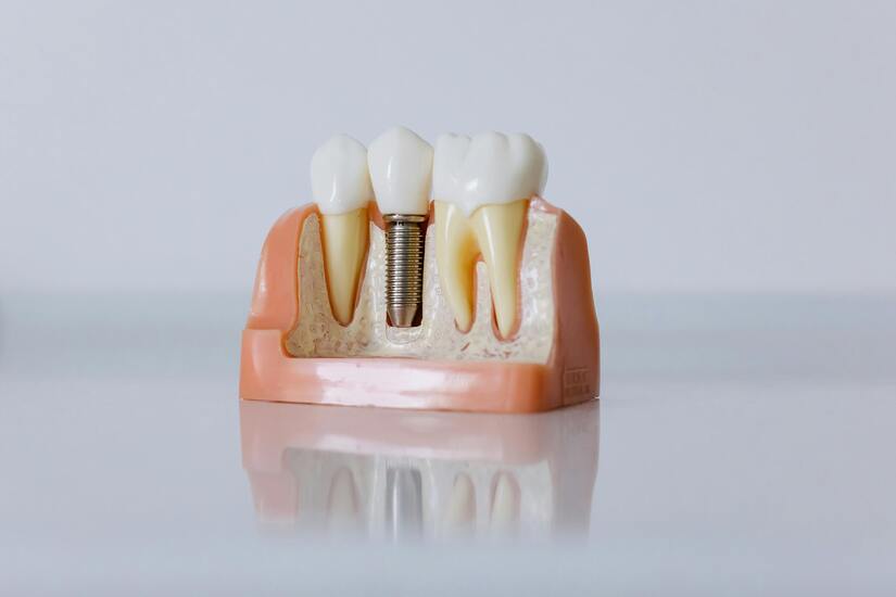 cuanto-dura-un-implante-dental