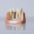 cuanto-dura-un-implante-dental