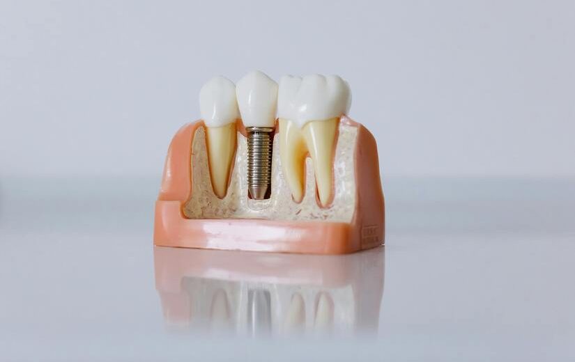 cuanto-dura-un-implante-dental