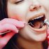 tartrectomia-dental