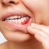 tratamiento-para-la-periodontitis
