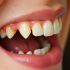 agenesia-dental