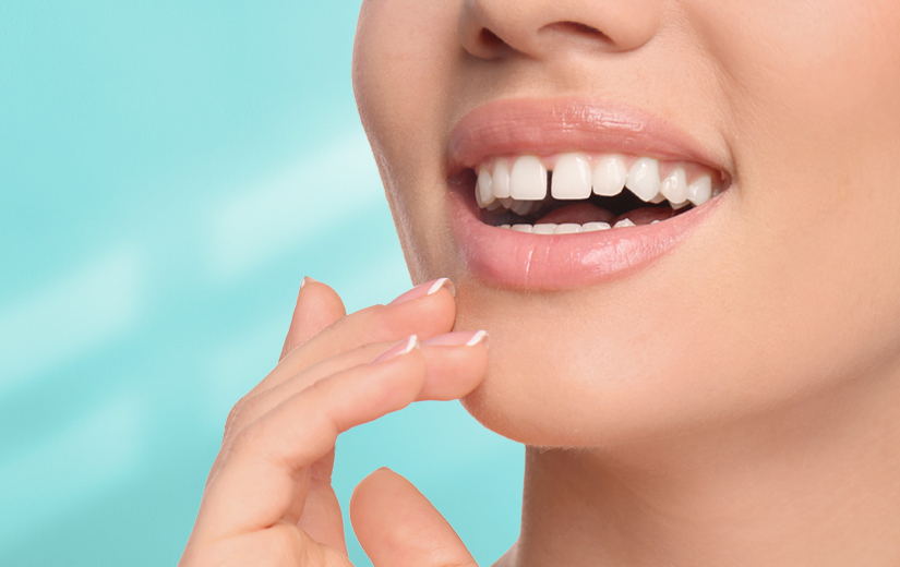 diastema-dental