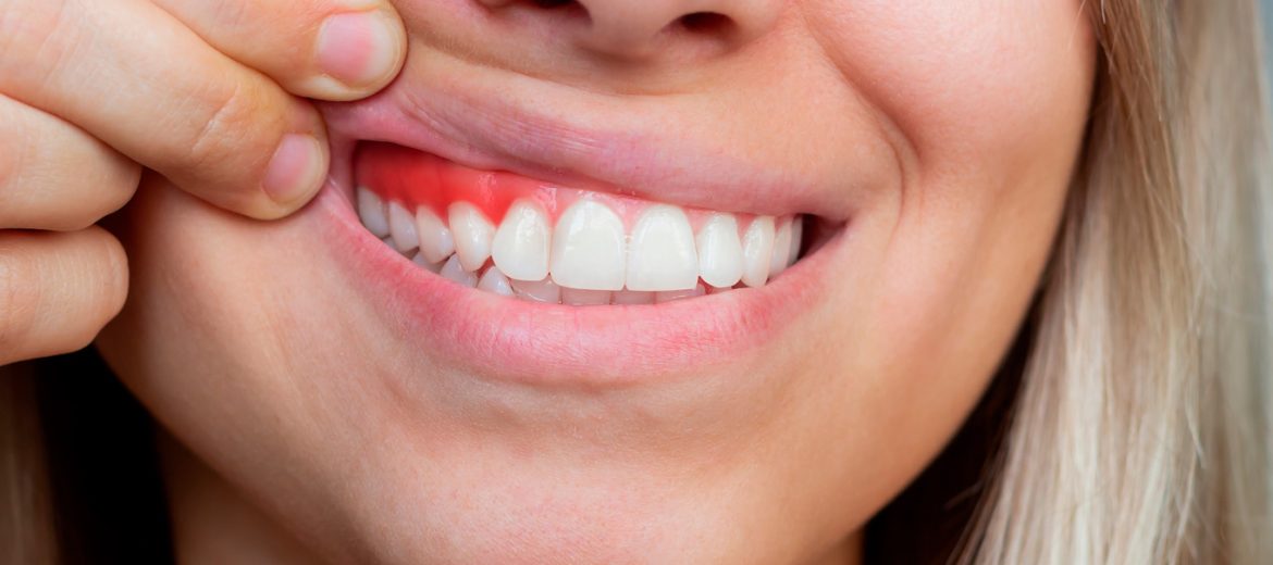 tratamiento de la periodontitis