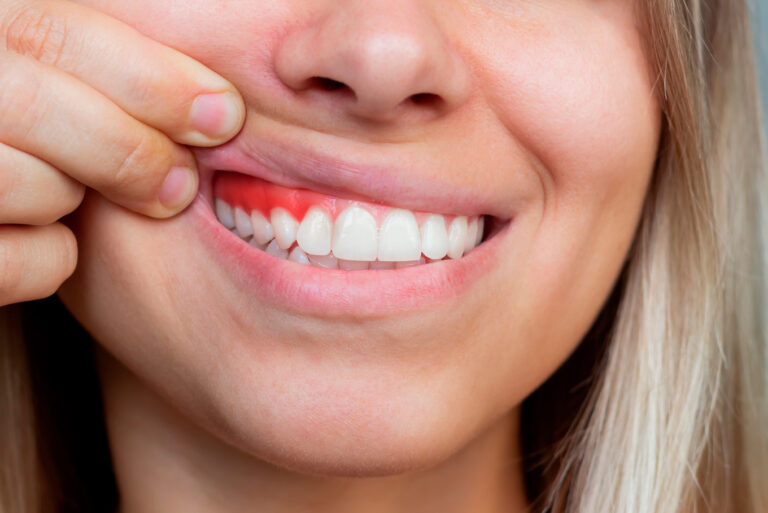 periodontitis-avanzada